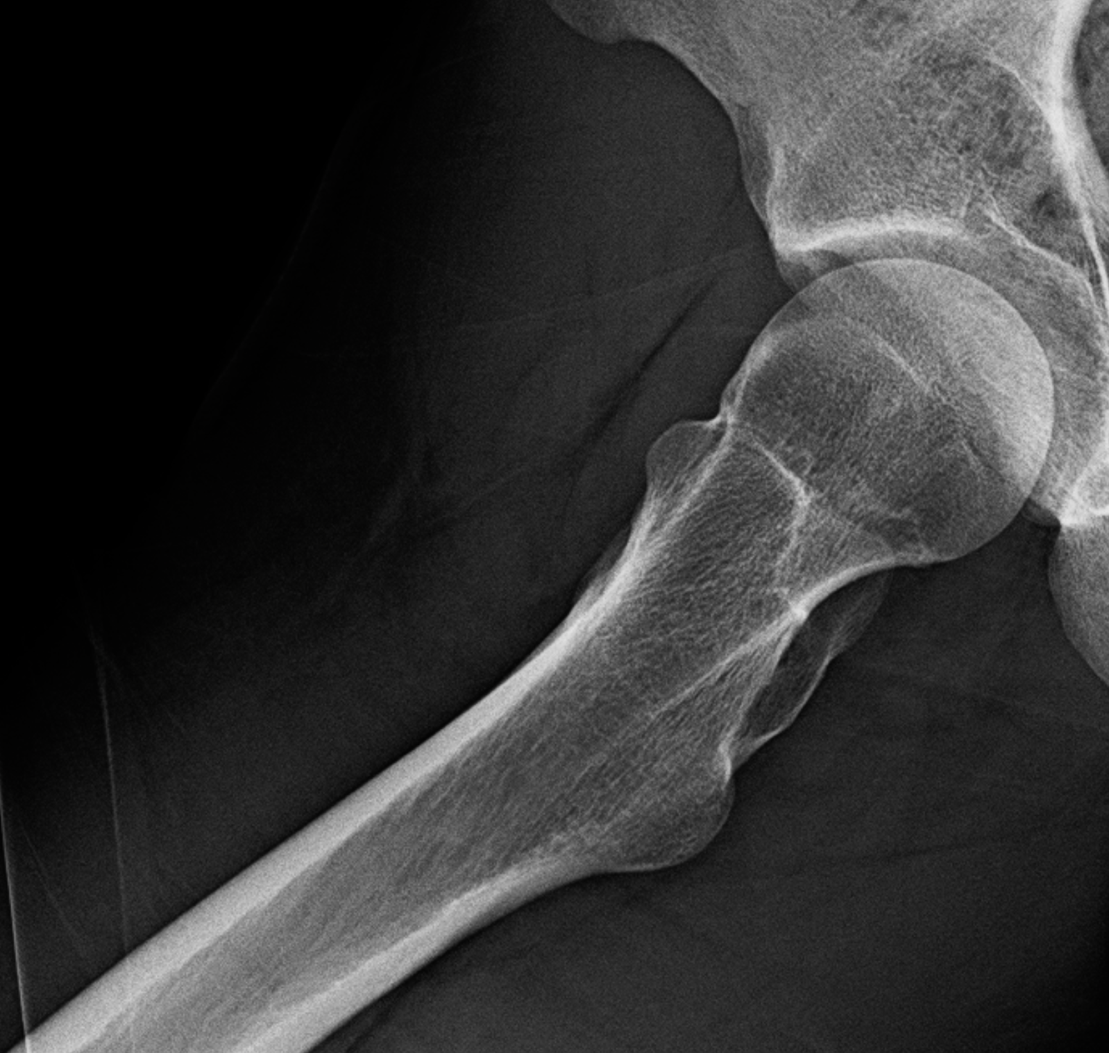 Hip X-Ray