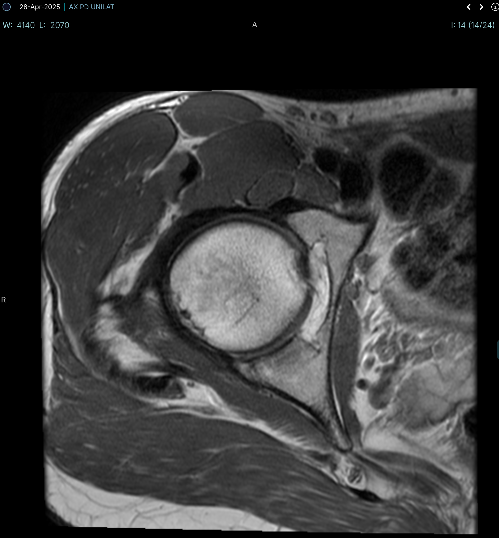 mri-04-28-2025-ax-pd-unilat