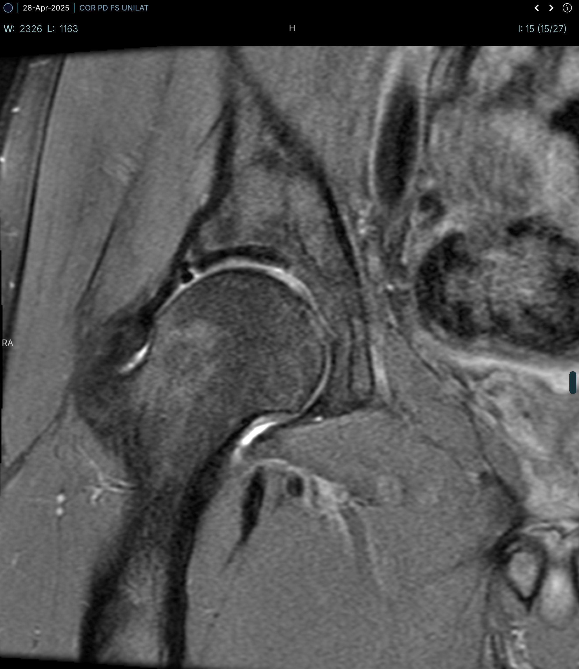 mri-04-28-2025-cor-pd-fs-unilat