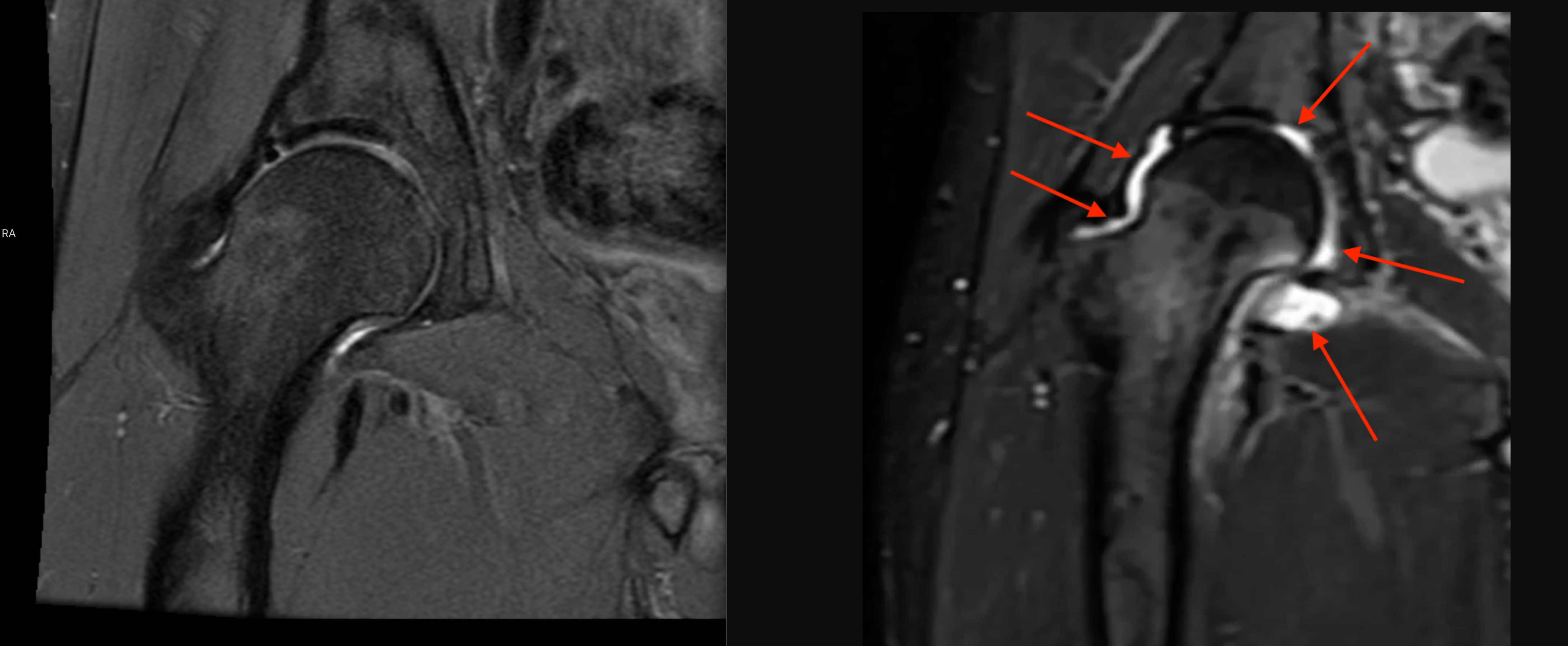 mri-14-month-vs-oct-2023